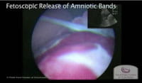 Watch: Fetoscopic Release of Amniotic Bands.